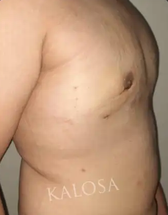 After gynecomastia Grade 3