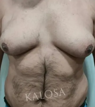Before gynecomastia surgery